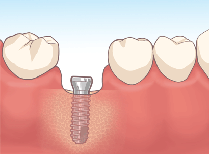 インプラントの埋入手術