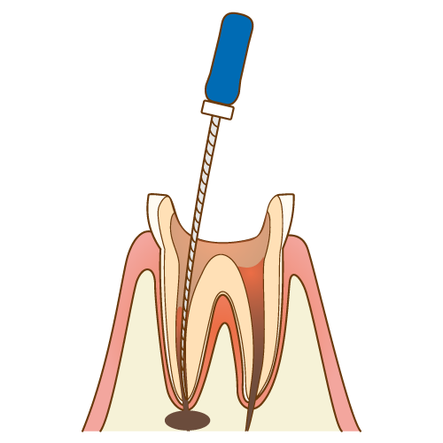 歯内療法