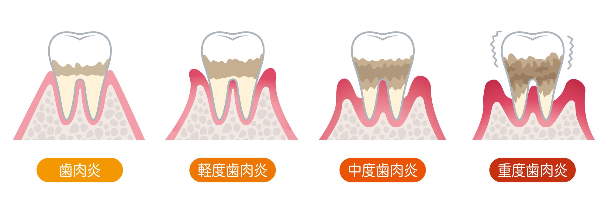 ステージ別歯周病